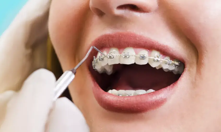 5 Biaya Pasang Behel 2025 di Semua Klinik/Rumah Sakit