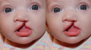 Biaya Operasi Bibir Sumbing