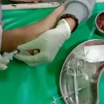 Biaya Operasi Mata Ikan