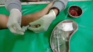 Biaya Operasi Mata Ikan