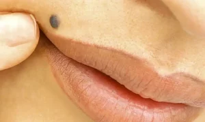 Biaya Operasi Tahi Lalat