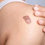 Biaya Operasi Keloid